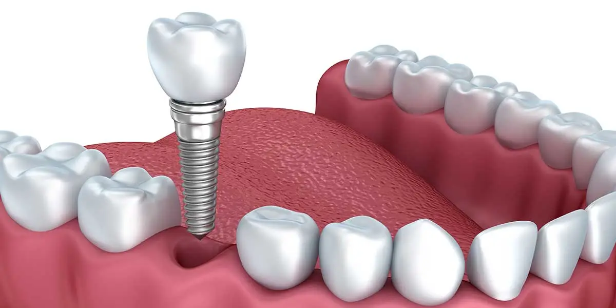 Implant unitaire